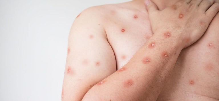 Casos de monkeypox voltam a aparecer no RN; Sesap reforça orientações
